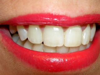 Białe zęby od zaraz